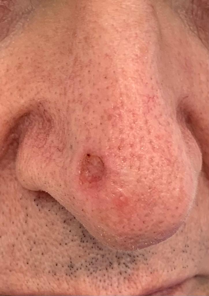 2. Shave Biopsy